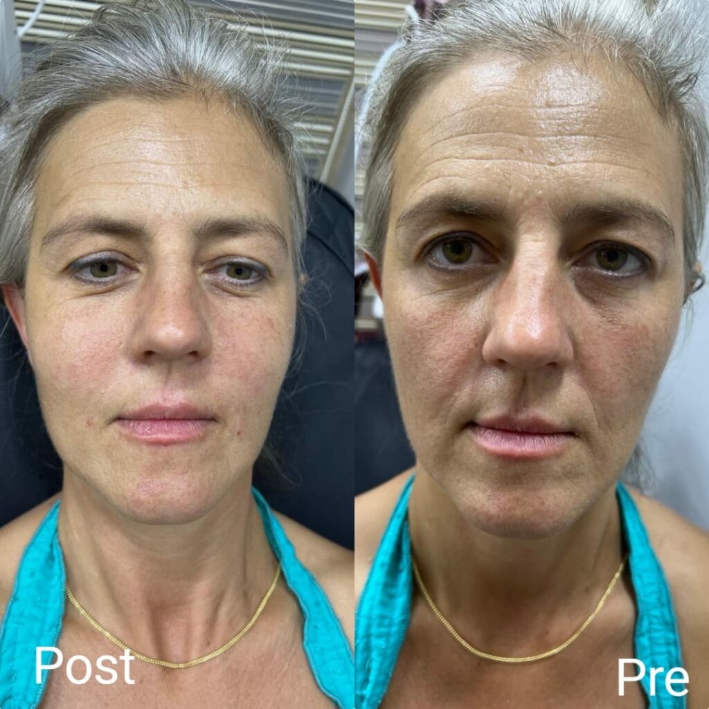 Olidia injection before and after